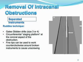 40
Ruddles technique:
• Gates Glidden drills (size 3 or 4)
• Circumferential “staging platform” at
the coronal aspect of the
obstruction.
• Fine tips can be used to work
counterclockwise around broken
instruments to cause unscrewing
Separated
Instruments
 