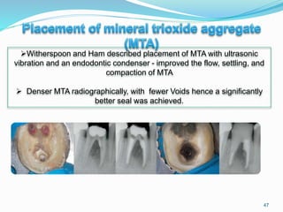 47
Witherspoon and Ham described placement of MTA with ultrasonic
vibration and an endodontic condenser - improved the flow, settling, and
compaction of MTA
 Denser MTA radiographically, with fewer Voids hence a significantly
better seal was achieved.
 