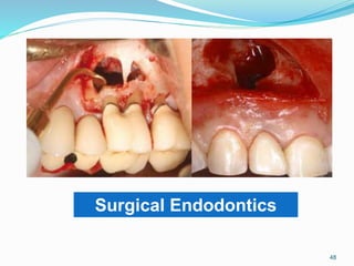 Surgical Endodontics
48
 