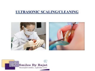 ULTRASONIC SCALING/CLEANING
 