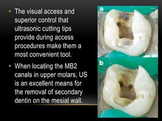 • The visual access and
superior control that
ultrasonic cutting tips
provide during access
procedures make them a
most convenient tool.
• When locating the MB2
canals in upper molars, US
is an excellent means for
the removal of secondary
dentin on the mesial wall.
 