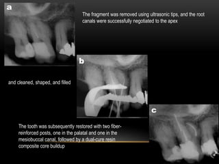 The fragment was removed using ultrasonic tips, and the root
canals were successfully negotiated to the apex
and cleaned, shaped, and filled
The tooth was subsequently restored with two fiber-
reinforced posts, one in the palatal and one in the
mesiobuccal canal, followed by a dual-cure resin
composite core buildup
 