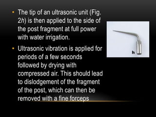 • The tip of an ultrasonic unit (Fig.
2h) is then applied to the side of
the post fragment at full power
with water irrigation.
• Ultrasonic vibration is applied for
periods of a few seconds
followed by drying with
compressed air. This should lead
to dislodgement of the fragment
of the post, which can then be
removed with a fine forceps
 