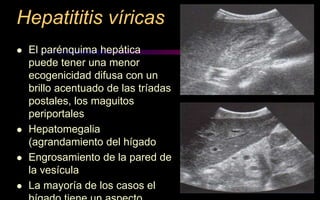 Hepatititis víricas
 El parénquima hepática
puede tener una menor
ecogenicidad difusa con un
brillo acentuado de las tríadas
postales, los maguitos
periportales
 Hepatomegalia
(agrandamiento del hígado
 Engrosamiento de la pared de
la vesícula
 La mayoría de los casos el
 