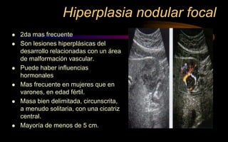 Hiperplasia nodular focal
 2da mas frecuente
 Son lesiones hiperplásicas del
desarrollo relacionadas con un área
de malformación vascular.
 Puede haber influencias
hormonales
 Mas frecuente en mujeres que en
varones, en edad fértil.
 Masa bien delimitada, circunscrita,
a menudo solitaria, con una cicatriz
central.
 Mayoría de menos de 5 cm.
 