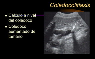 Coledocolitiasis
 Cálculo a nivel
del colédoco
 Colédoco
aumentado de
tamaño
 