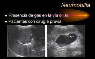 Neumobilia
 Presencia de gas en la vía biliar.
 Pacientes con cirugía previa
 