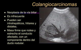 Colangiocarcinomas
 Neoplasia de la vía biliar
 Es infrecuente
 Pueden ser
intrahepáticos, hiliares y
distales.
 Masa firme que rodea y
estrecha el conducto
afectado, con un
componente dentro del
ducto nodular.
 