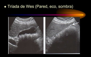  Tríada de Wes (Pared, eco, sombra)
 