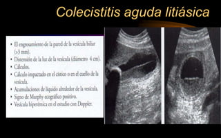 Colecistitis aguda litiásica
 