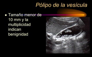 Pólipo de la vesícula
 Tamaño menor de
10 mm y la
multiplicidad
indican
benignidad
 