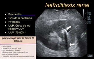 Nefrolitiasis renal
 Frecuentes
 12% de la población
 >Varones
 UUP, Cruce de los
iliacos y UUV
 UUV (75-80%)
 
