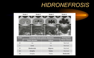 HIDRONEFROSIS
 