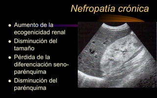 Nefropatía crónica
 Aumento de la
ecogenicidad renal
 Disminución del
tamaño
 Pérdida de la
diferenciación seno-
parénquima
 Disminución del
parénquima
 