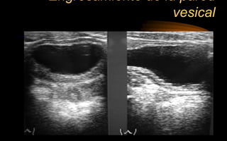 Engrosamiento de la pared
vesical
 