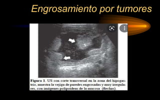 Engrosamiento por tumores
 