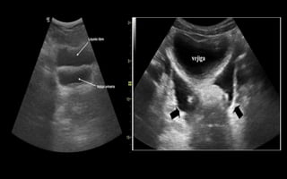 ULTRASONIDO ABDOMINAL.pptx
