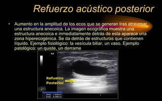 Refuerzo acústico posterior
• Aumento en la amplitud de los ecos que se generan tras atravesar
una estructura anecoica. La imagen ecográfica muestra una
estructura anecoica e inmediatamente detrás de esta aparece una
zona hiperecogénica. Se da detrás de estructuras que contienen
líquido. Ejemplo fisiológico: la vesícula biliar, un vaso. Ejemplo
patológico: un quiste, un derrame
 