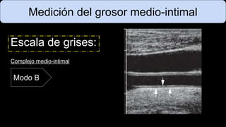 Medición del grosor medio-intimal
Escala de grises:
Complejo medio-intimal
Modo B
 