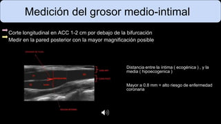 Medición del grosor medio-intimal
Corte longitudinal en ACC 1-2 cm por debajo de la bifurcación
Medir en la pared posterior con la mayor magnificación posible
Distancia entre la íntima ( ecogénica ) , y la
media ( hipoecogenica )
Mayor a 0.8 mm = alto riesgo de enfermedad
coronaria
 