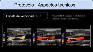 Protocolo : Aspectos técnicos
Escala de velocidad : PRF -Ajustar en 30-40 cm/sc para un estudio normal
- Ajustar la velocidad según el aliasing
 