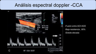 Análisis espectral doppler -CCA
-Fusión entre ACI+ACE
-Baja resistencia , 80%
-Sístole elevada
 