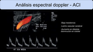 Análisis espectral doppler - ACI
-Baja resistencia
-Lecho vascular cerebral
-Aumento en diástole ,
disminución en sístole
 
