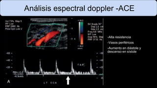 Análisis espectral doppler -ACE
-Alta resistencia
-Vasos periféricos
-Aumento en diástole y
descenso en sístole
 