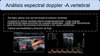 Análisis espectral doppler -A.vertebral
-Se debe valorar una vez terminado el exámen carotídeo.
-Localizar la arteria carótida interna longitudinalmente , luego angular
medialmente hasta encontrar los cuerpos vertebrales , luego rotar lateralmente
para encontrar los procesos transversos y los vasos vertebrales.
-Valorar permeabilidad y dirección de flujo .
 