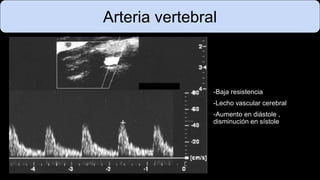Arteria vertebral
-Baja resistencia
-Lecho vascular cerebral
-Aumento en diástole ,
disminución en sístole
 