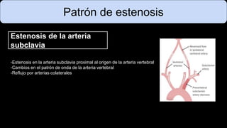 Patrón de estenosis
Estenosis de la arteria
subclavia
-Estenosis en la arteria subclavia proximal al origen de la arteria vertebral
-Cambios en el patrón de onda de la arteria vertebral
-Reflujo por arterias colaterales
 