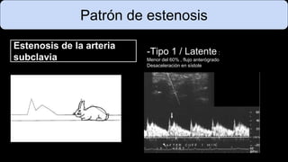 Patrón de estenosis
Estenosis de la arteria
subclavia
-Tipo 1 / Latente :
Menor del 60% , flujo anterógrado
Desaceleración en sístole
 