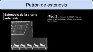 Patrón de estenosis
Estenosis de la arteria
subclavia
-Tipo 2 : Estenosis de 60-90% , flujo por
debajo de la línea de base , bifásico , inversión del
flujo en sístole
 