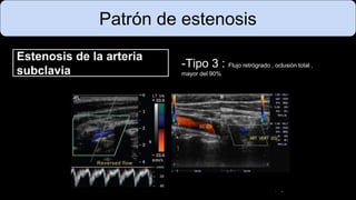 Patrón de estenosis
Estenosis de la arteria
subclavia
-Tipo 3 : Flujo retrógrado , oclusión total ,
mayor del 90%
 