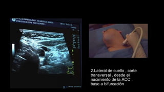 2.Lateral de cuello , corte
transversal , desde el
nacimiento de la ACC ,
base a bifurcación
 
