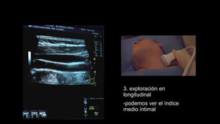 3. exploración en
longitudinal
-podemos ver el índice
medio intimal
 