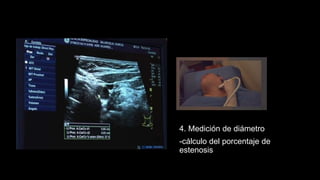 4. Medición de diámetro
-cálculo del porcentaje de
estenosis
 