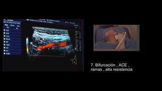 7. Bifurcación , ACE ,
ramas , alta resistencia
 