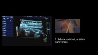 9. Arteria vertebral, apófisis
transversas
 