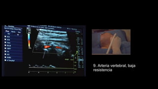 9. Arteria vertebral, baja
resistencia
 