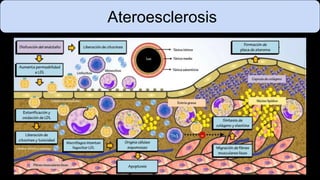 Ateroesclerosis
 