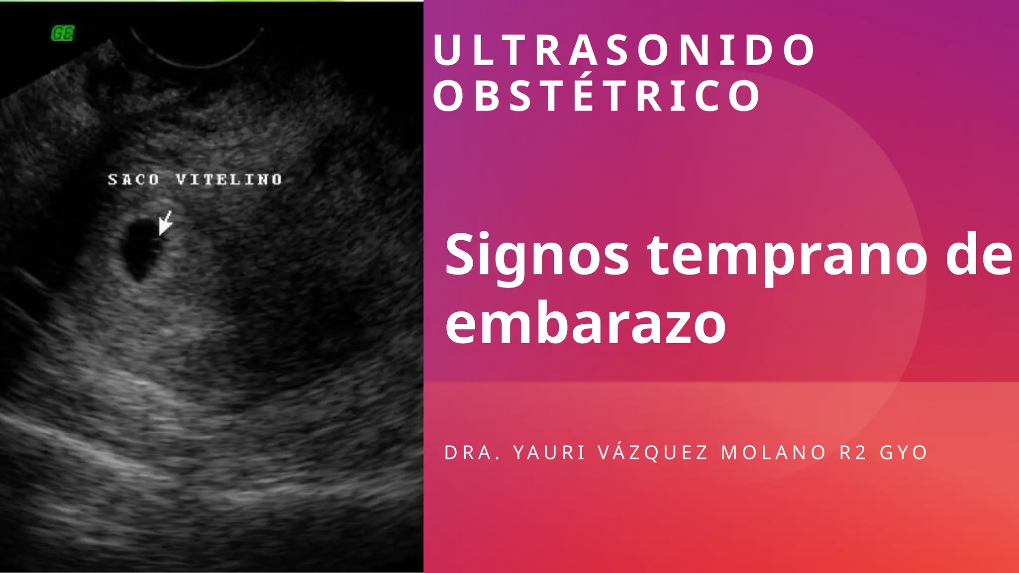 U L T R A S O N I D O
O B S T É T R I C O
D R A . Y A U R I V Á Z Q U E Z M O L A N O R 2 G Y O
Signos temprano de
embarazo
 