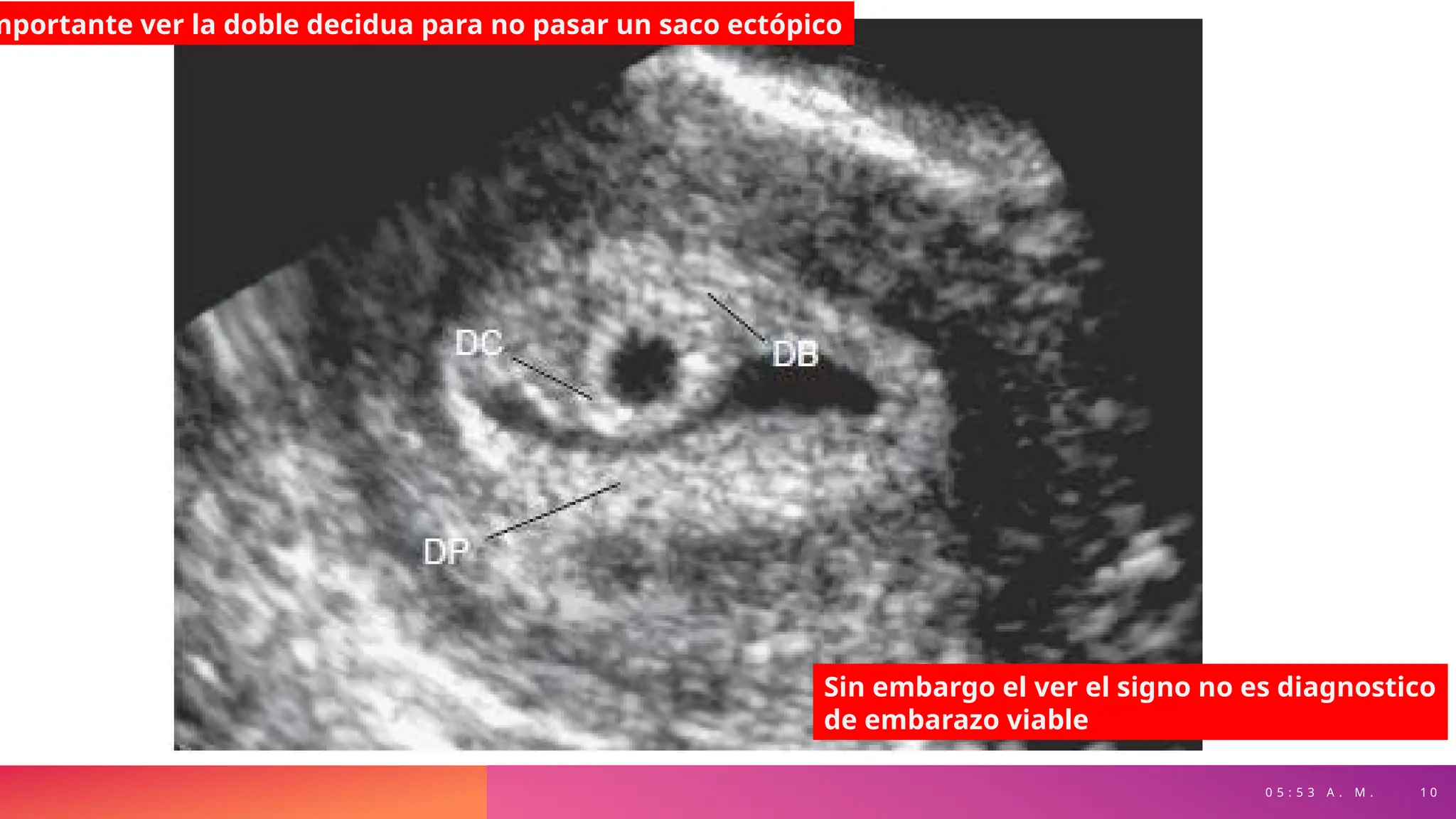 0 5 : 5 3 A . M . 1 0
mportante ver la doble decidua para no pasar un saco ectópico
Sin embargo el ver el signo no es diagnostico
de embarazo viable
 
