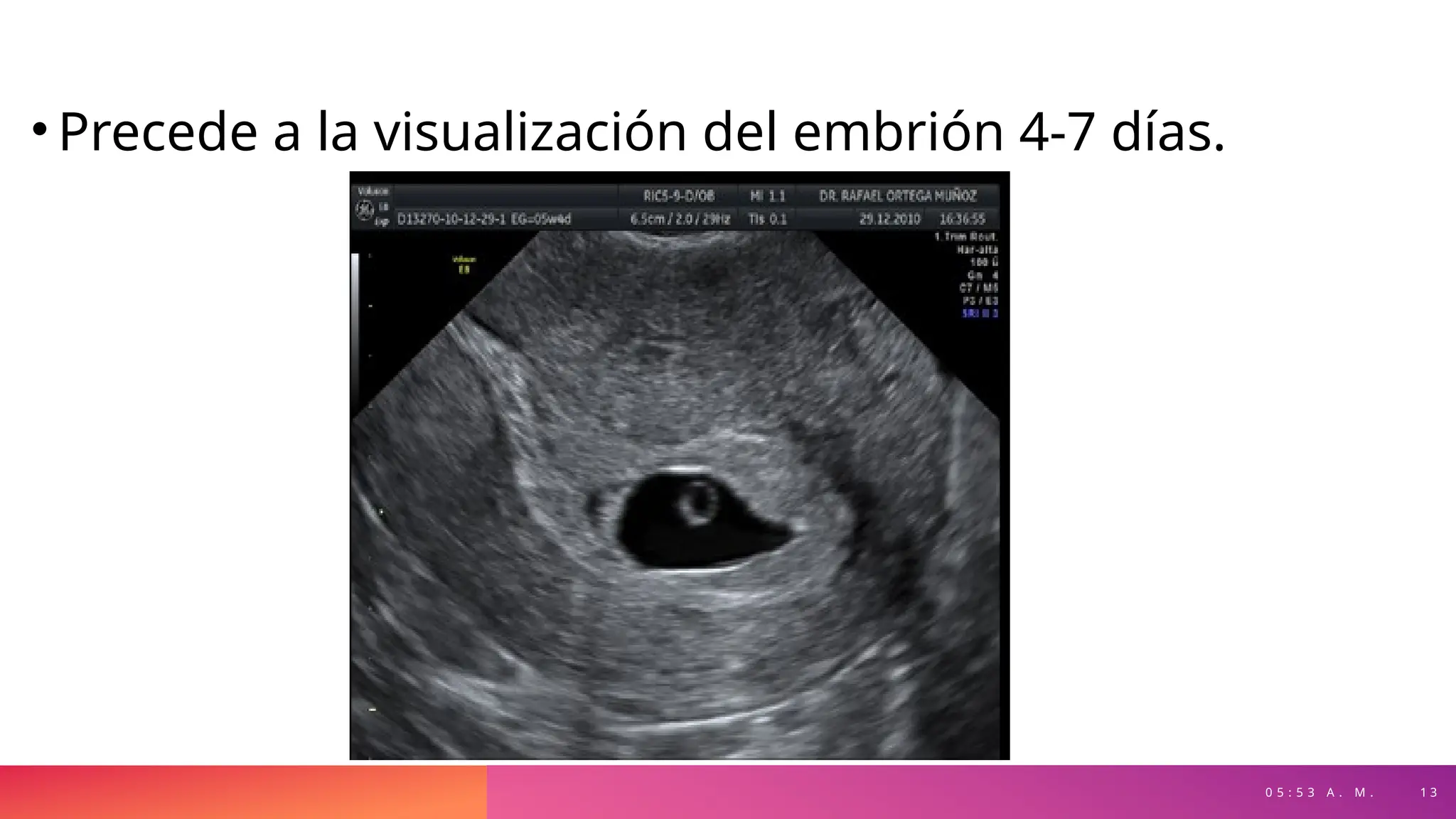 0 5 : 5 3 A . M . 1 3
• Precede a la visualización del embrión 4-7 días.
 