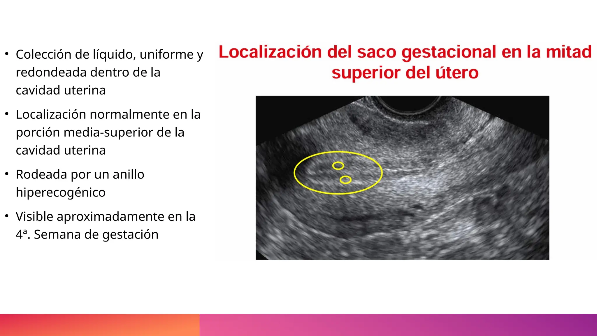 • Colección de líquido, uniforme y
redondeada dentro de la
cavidad uterina
• Localización normalmente en la
porción media-superior de la
cavidad uterina
• Rodeada por un anillo
hiperecogénico
• Visible aproximadamente en la
4ª. Semana de gestación
 