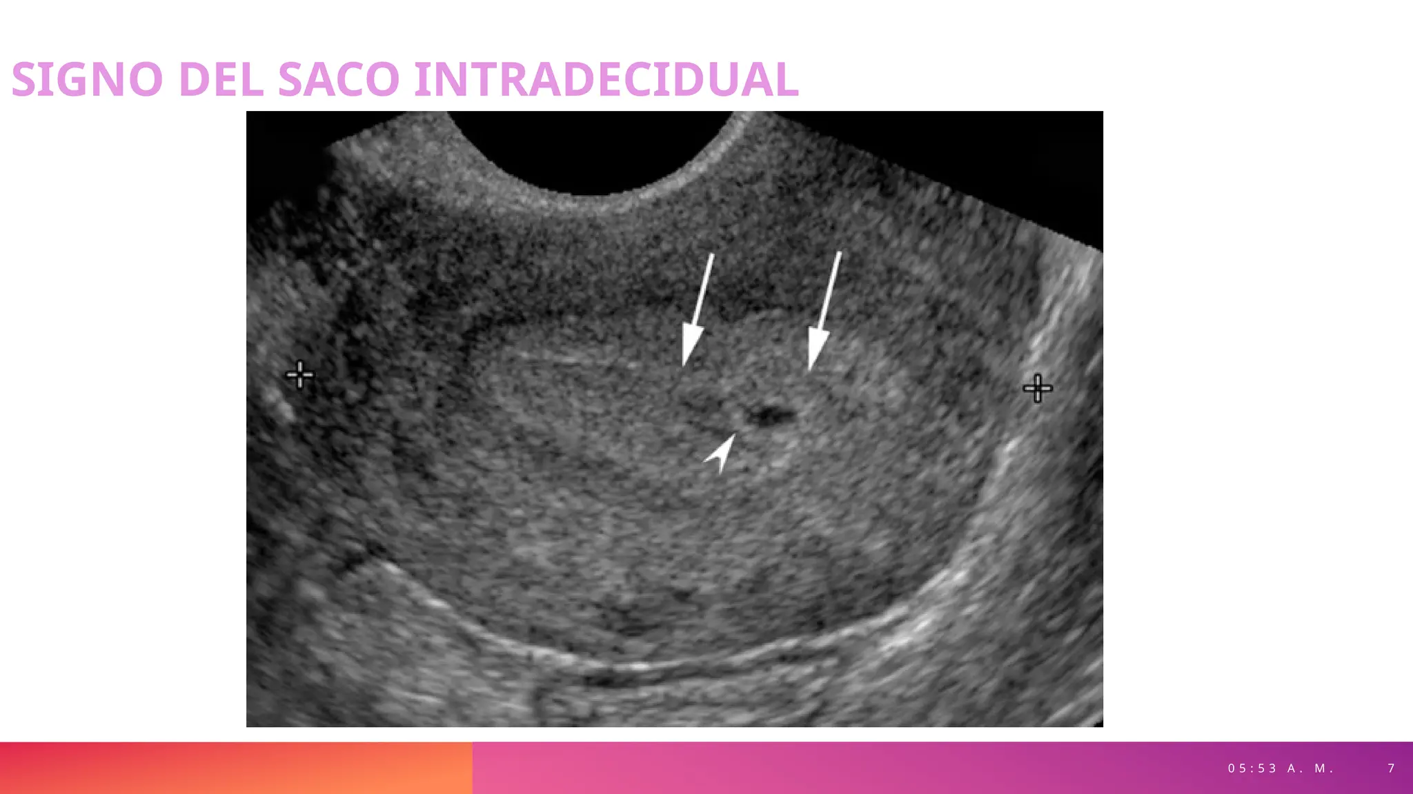 SIGNO DEL SACO INTRADECIDUAL
0 5 : 5 3 A . M . 7
 