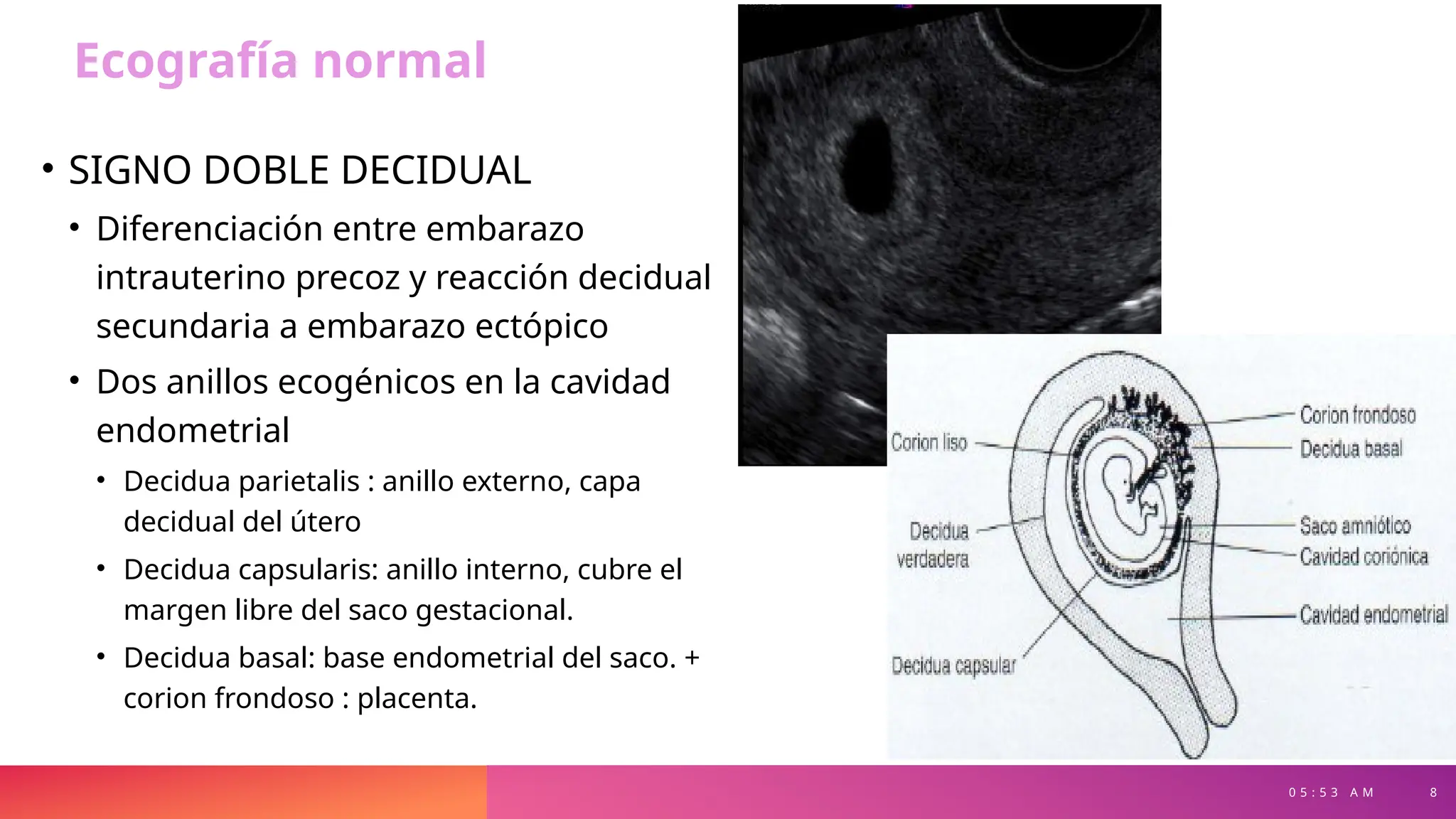 0 5 : 5 3 A M 8
• SIGNO DOBLE DECIDUAL
• Diferenciación entre embarazo
intrauterino precoz y reacción decidual
secundaria a embarazo ectópico
• Dos anillos ecogénicos en la cavidad
endometrial
• Decidua parietalis : anillo externo, capa
decidual del útero
• Decidua capsularis: anillo interno, cubre el
margen libre del saco gestacional.
• Decidua basal: base endometrial del saco. +
corion frondoso : placenta.
Ecografía normal
 