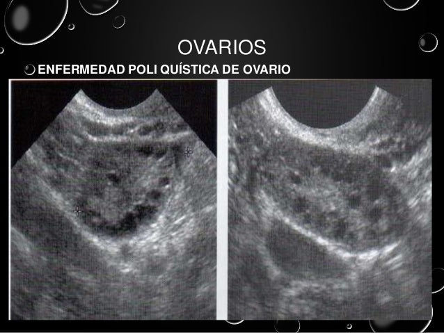 ultrasonido pelvico ultrasonidos pelvicos