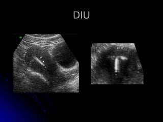 DIU 