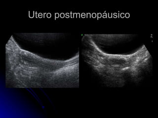 Utero postmenopáusico 